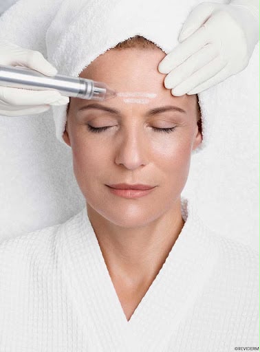 Mikrodermabrasion mit dem REVIDERM Skin Peeler an der Stirn